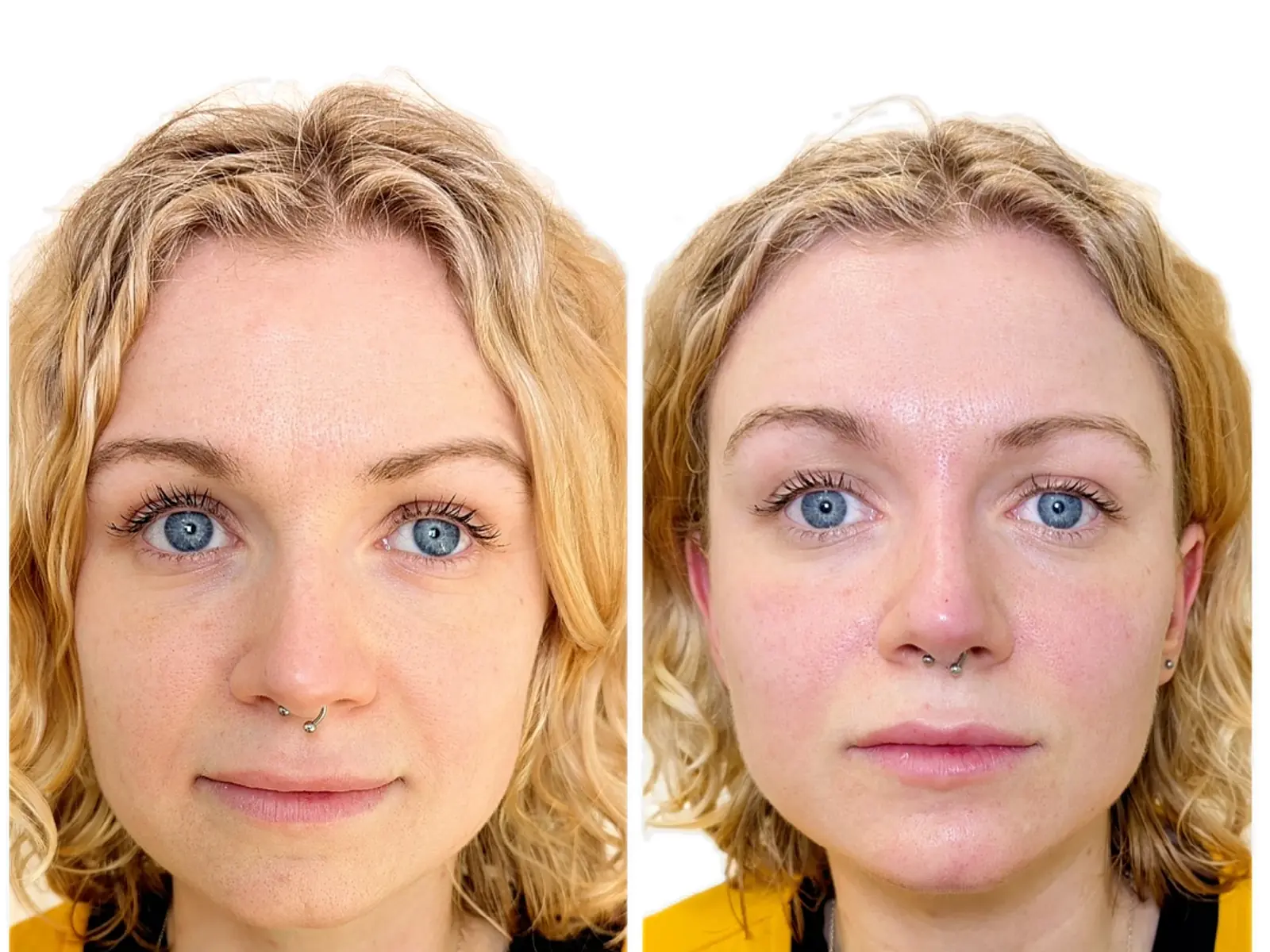 Dermal Fillers & Facial Balancing at Mona Aesthetics