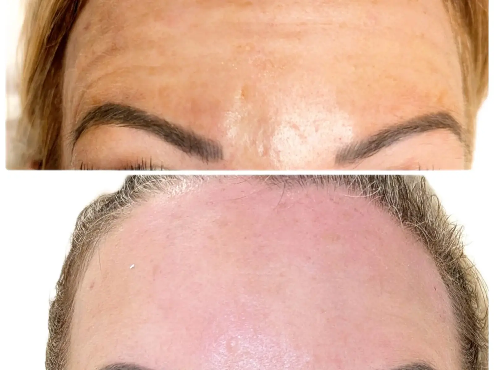 Anti-wrinkle treatment result shared with patient permission