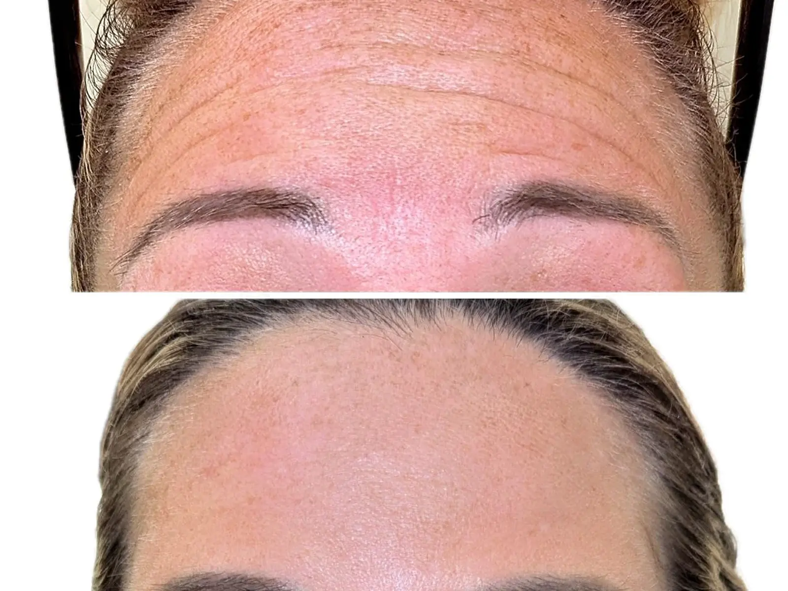 Anti-wrinkle treatment result shared with patient permission