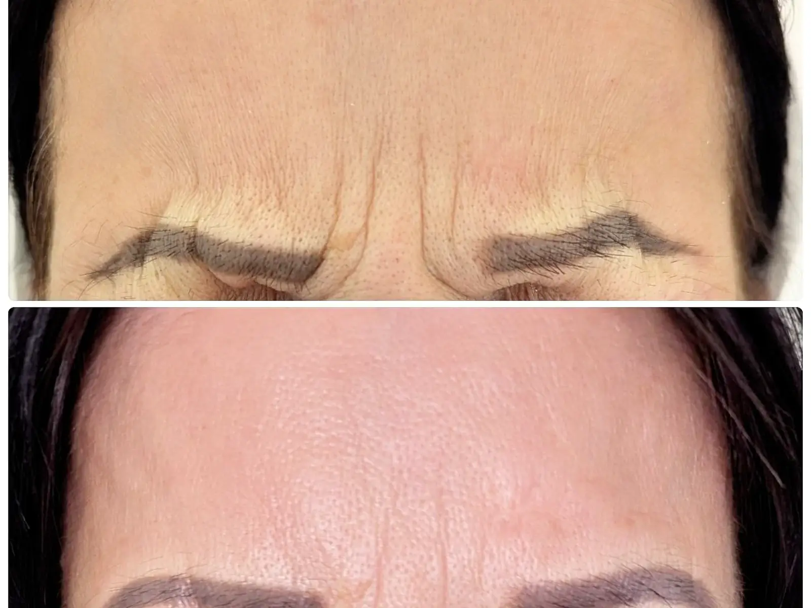 Anti-wrinkle treatment result shared with patient permission
