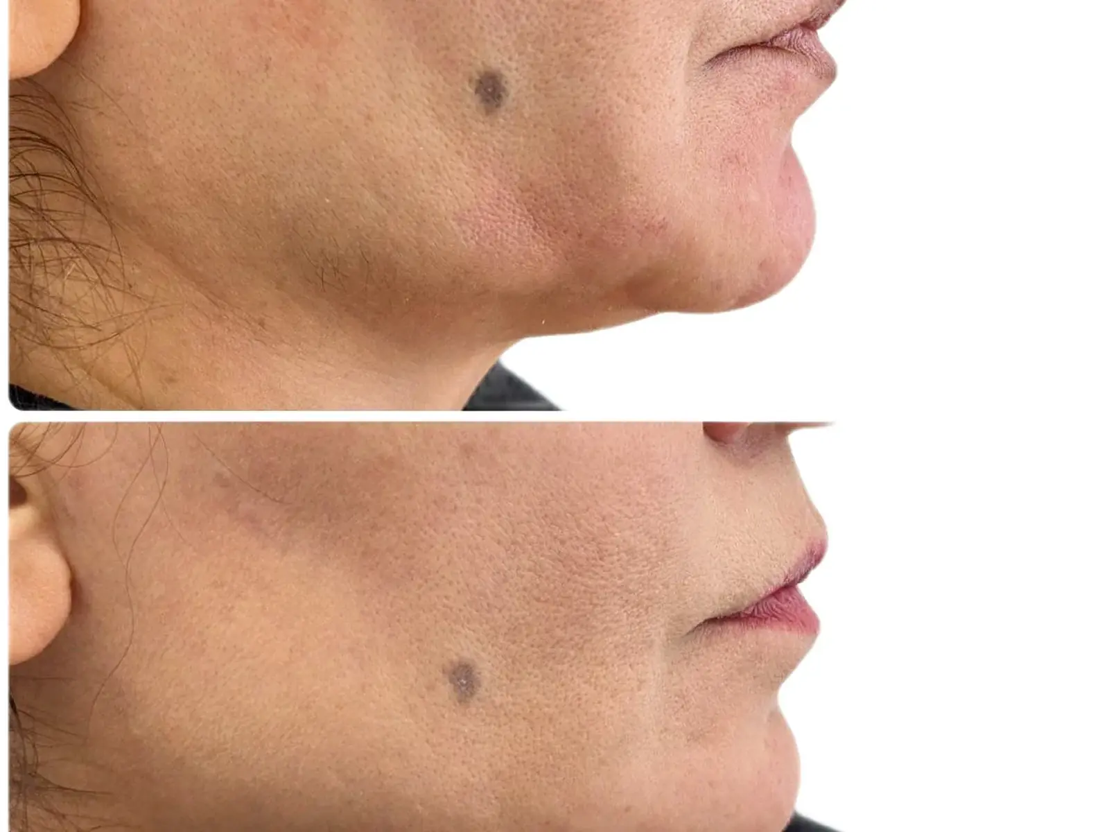 Anti-wrinkle treatment result shared with patient permission