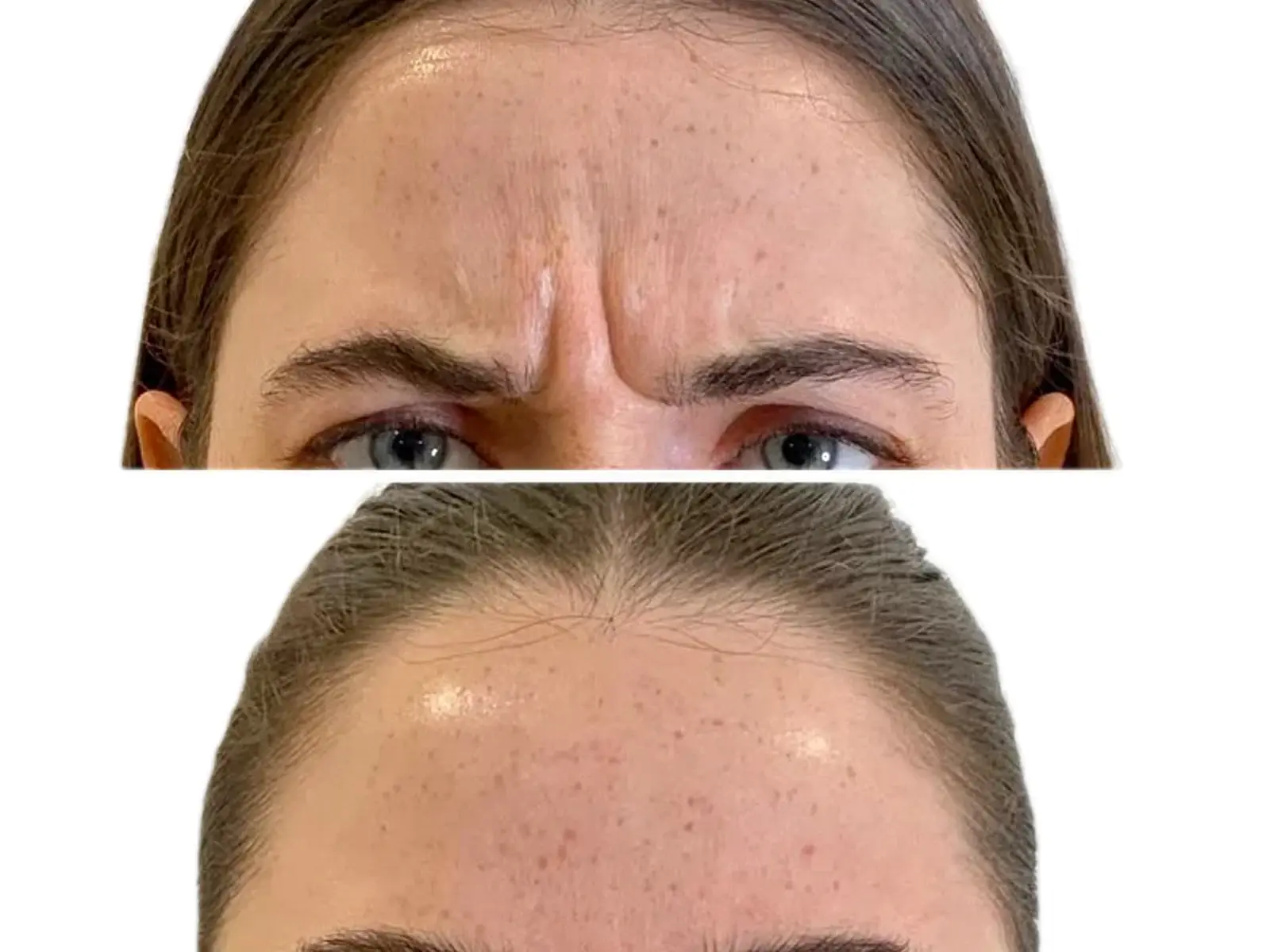 Anti-wrinkle treatment result shared with patient permission