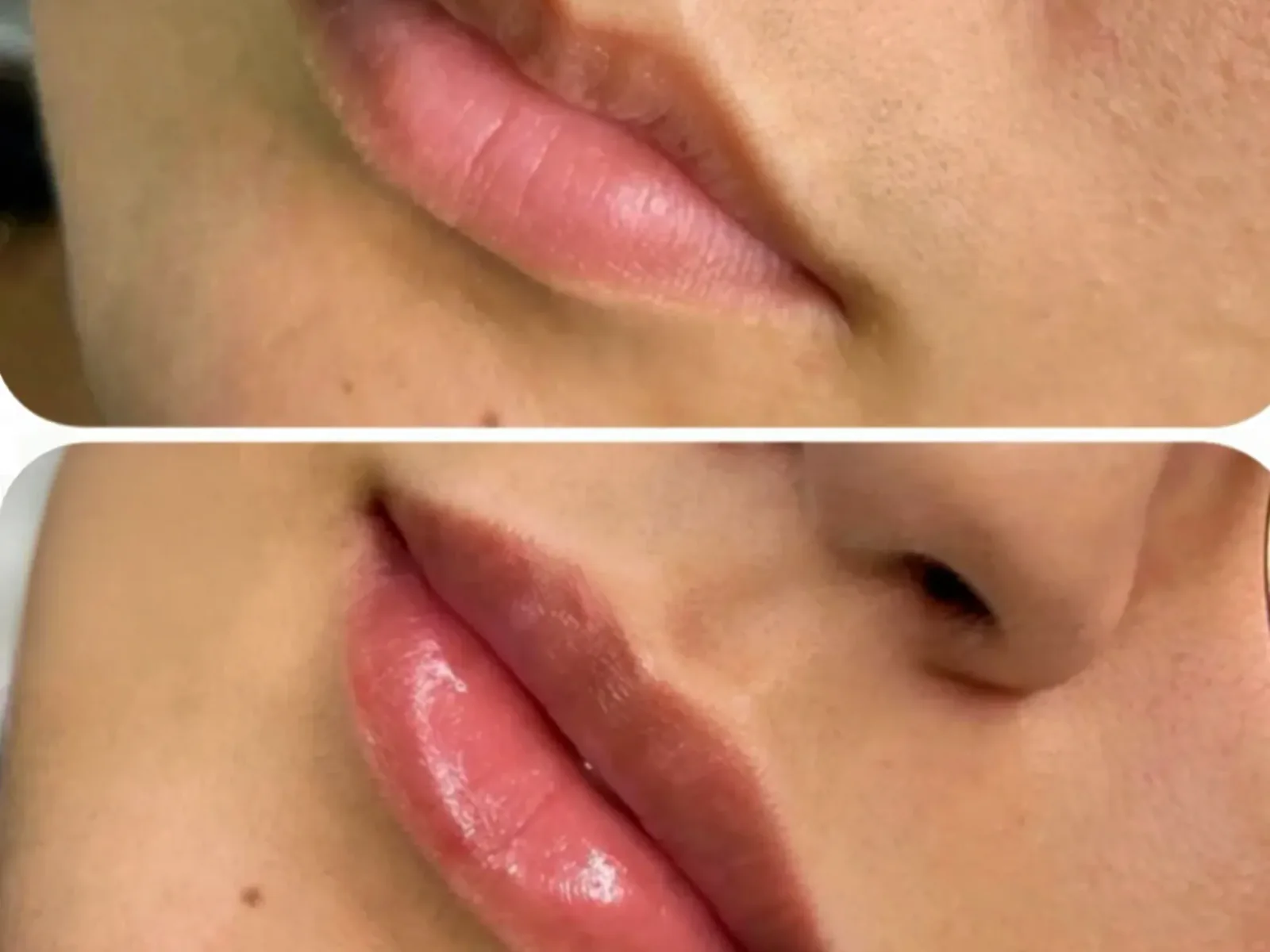 Lip enhancement result shared with patient permission