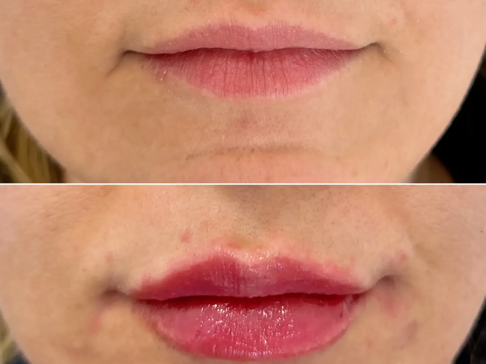 Lip Enhancement at Mona Aesthetics