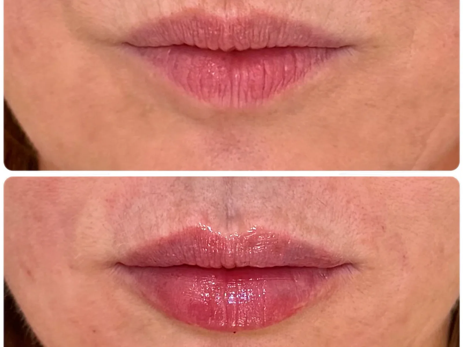 Lip enhancement result shared with patient permission