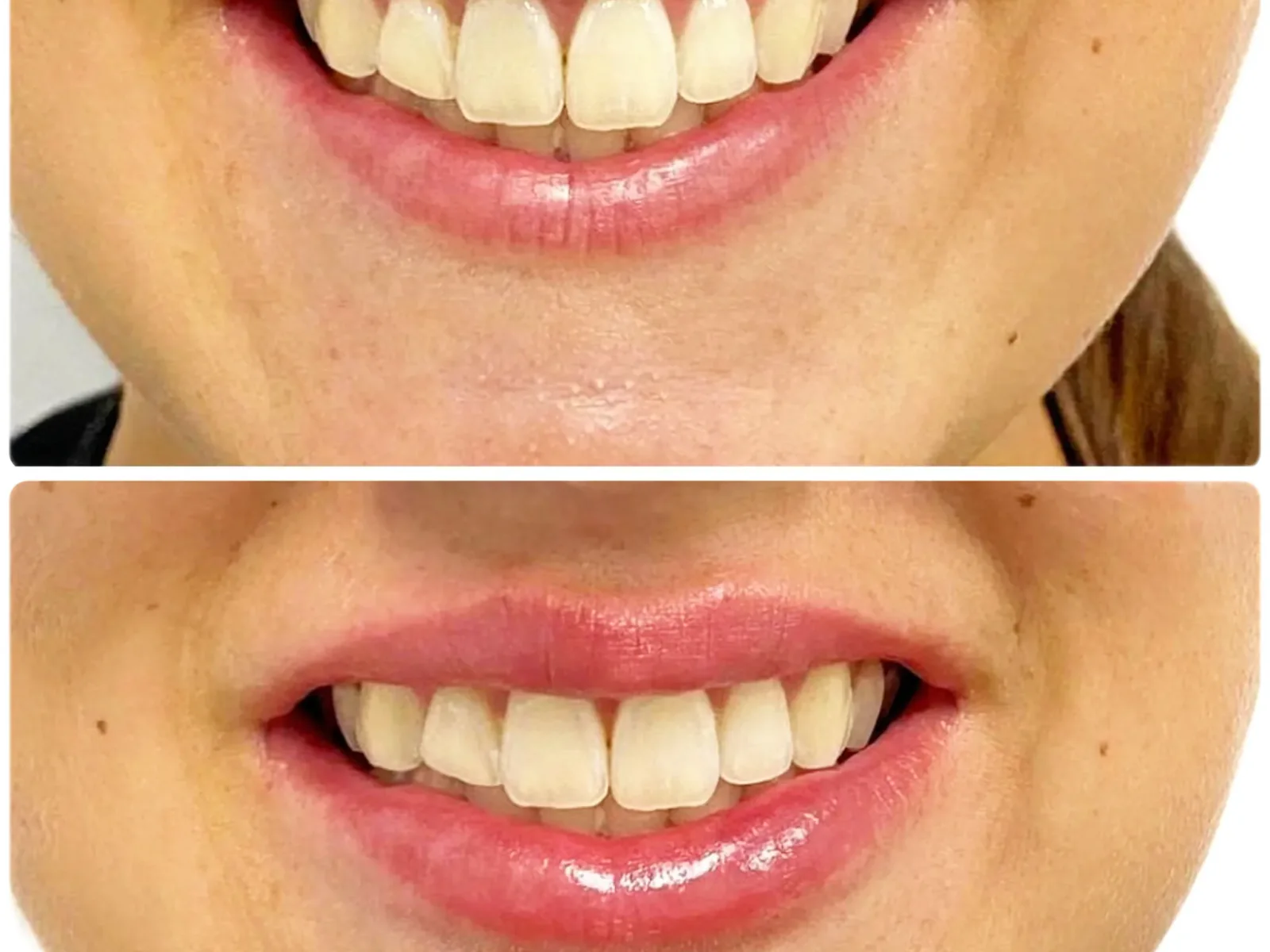 Lip enhancement result shared with patient permission