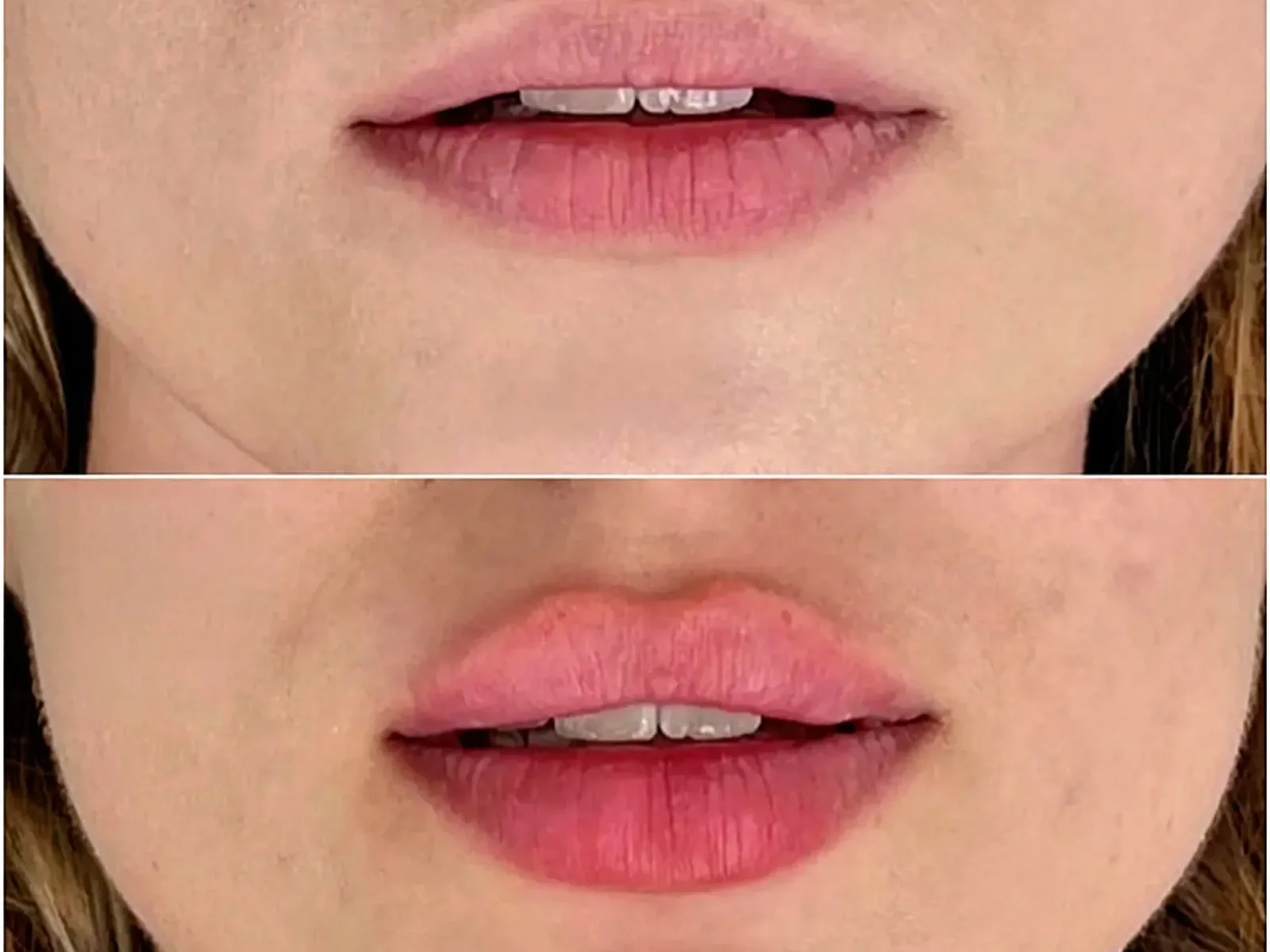 Lip enhancement result shared with patient permission