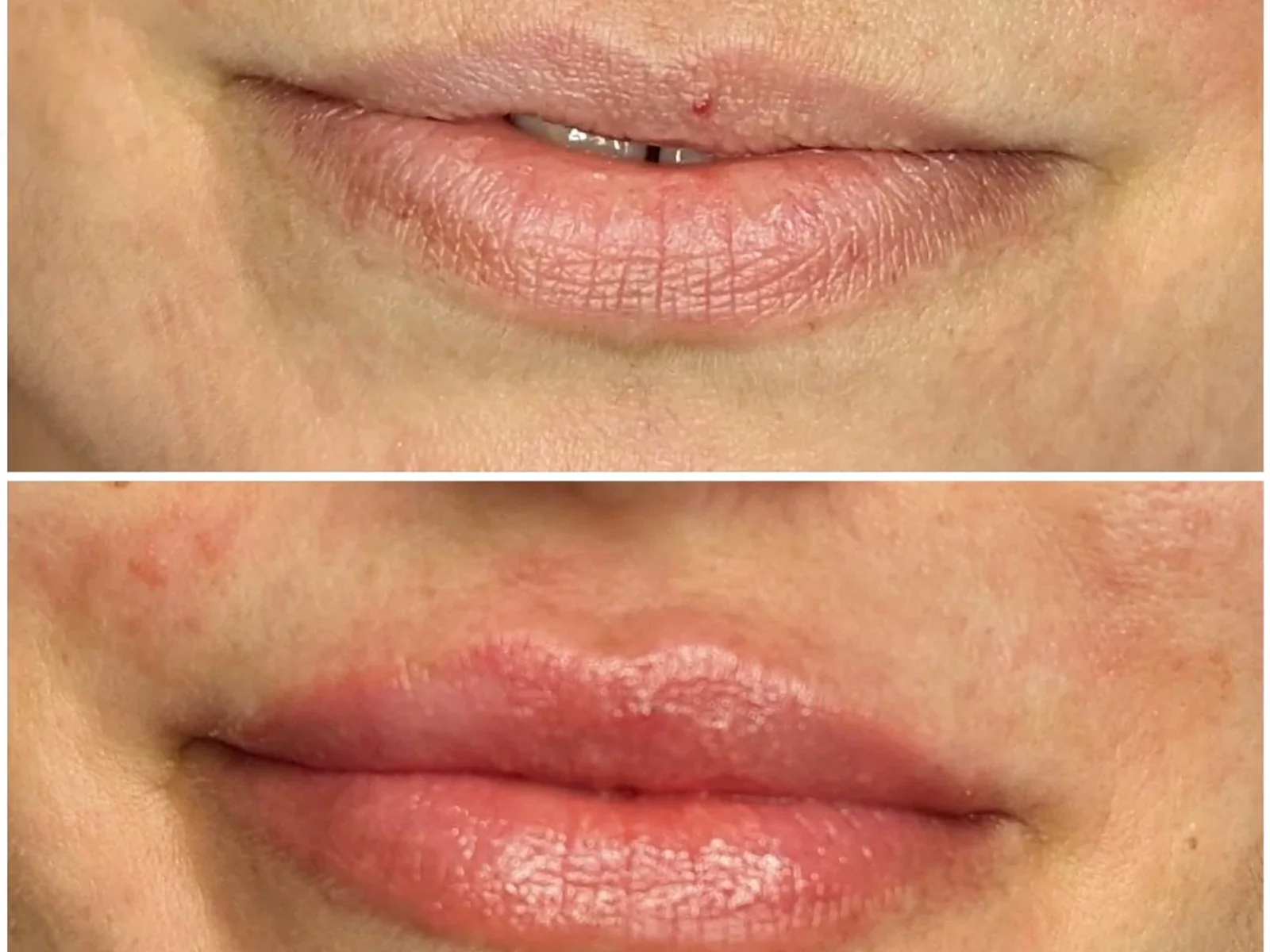 Lip enhancement result shared with patient permission