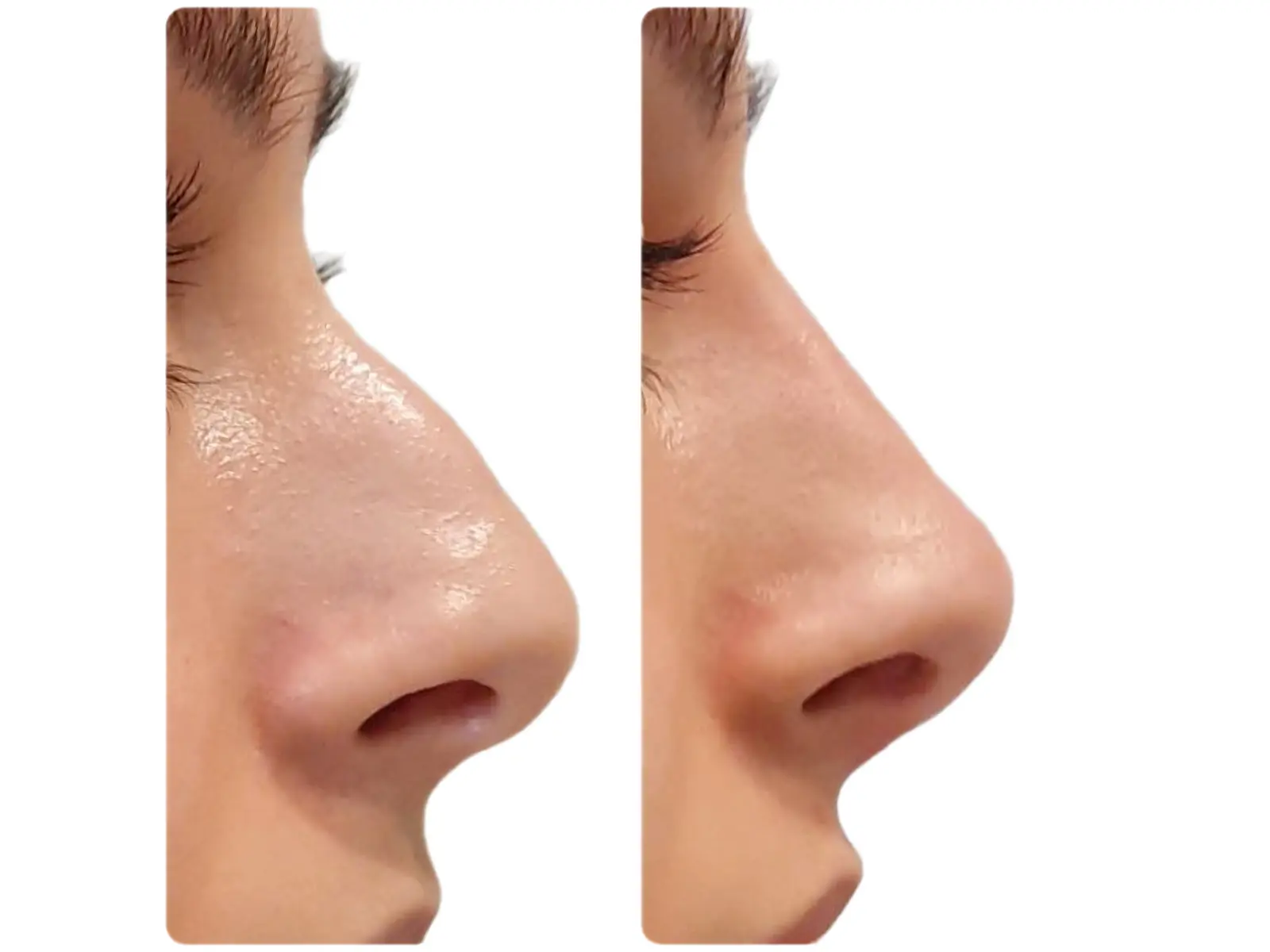 Profile comparison following non-surgical rhinoplasty result