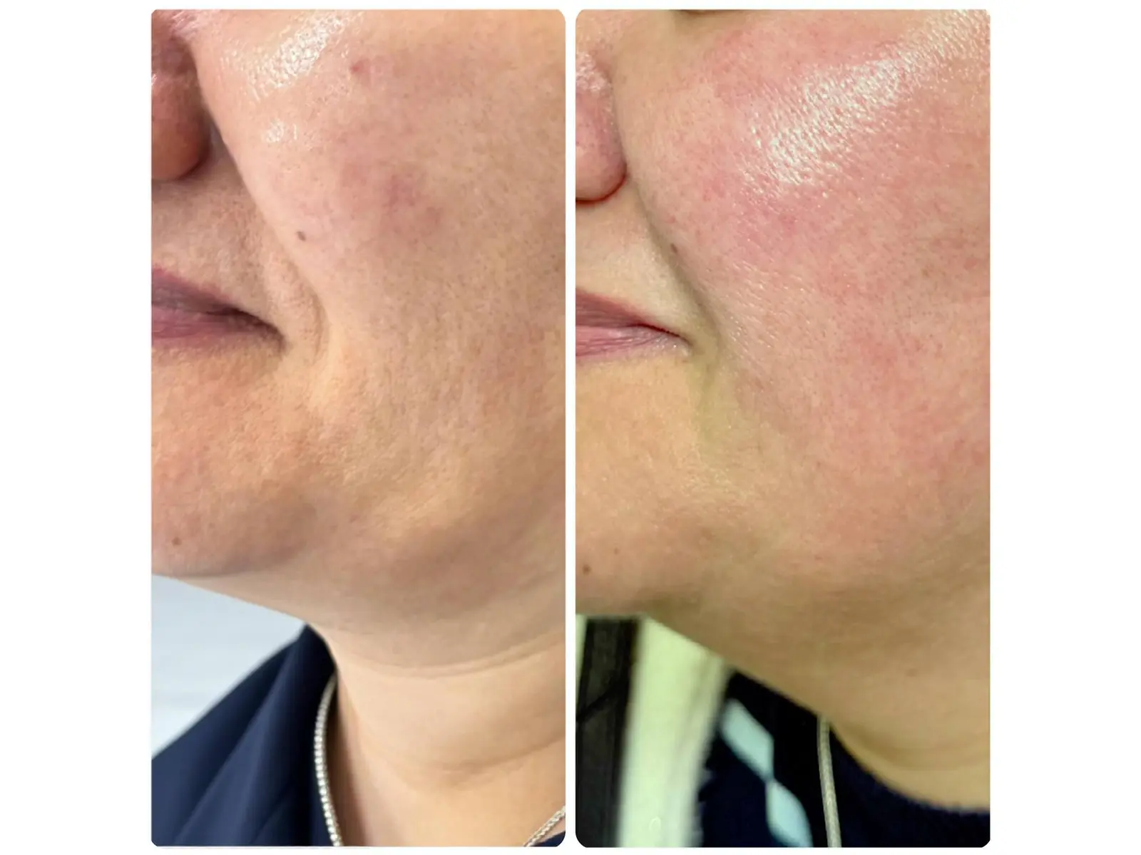 Skin Boosters at Mona Aesthetics